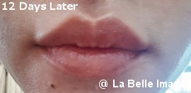 Lip Coloring 12days later