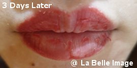 Lip Coloring 3days later