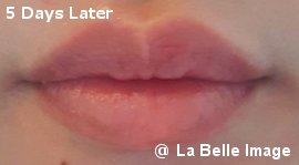 Lip Coloring 5days later