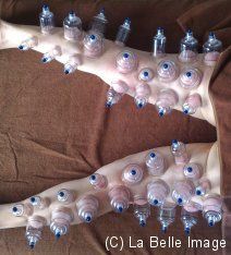 cupping-lower-body