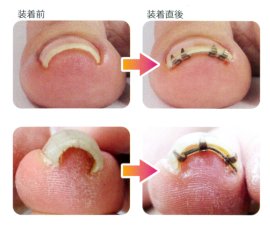 巻き爪矯正